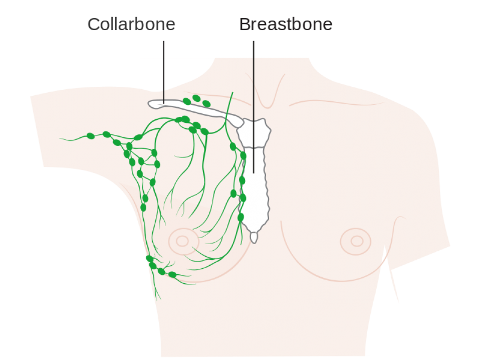 Lymph node surgery for breast cancer Irish Cancer Society